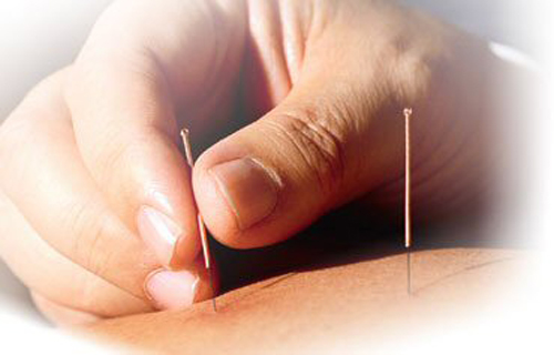 acupuncture.jpg